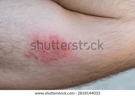 Macro shot showcasing a localized cluster of red skin papules and vesicles on hairy human skin, indicating an allergic reaction.