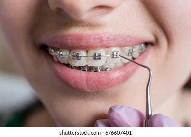 Macro Shot Of White Teeth With Braces. Smiling Female Patient With Metal Brackets At The Dental Office. Dentist Holding Probe. Orthodontic Treatment.