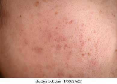 Macro Shot Of Woman Face Has Variety Problems On Her Skin (such As Acne, Pimple, Pores And Melasma Etc). Conceptual Of Natural Problem On Woman Skin.