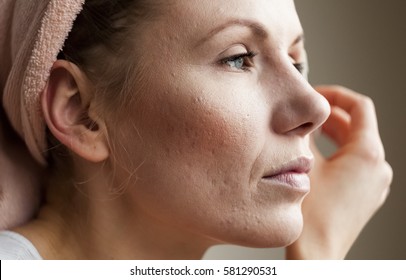 Macro Shot Of Young Woman's Cheek With Typical Problem With Acne, Acne Rosacea, And Pimples In The Adulthood Time.