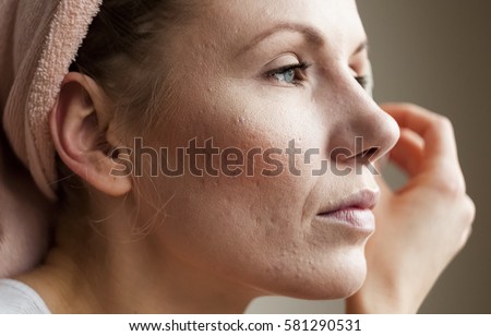 Macro shot of young woman's cheek with typical problem with acne, acne rosacea, and pimples in the adulthood time.