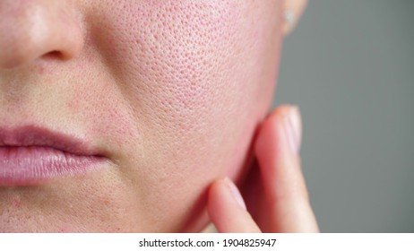 Macro skin with enlarged pores. Allergic reaction, peeling, care for problem skin.