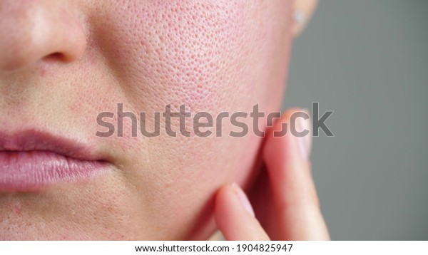 Macro skin with enlarged pores. Allergic\
reaction, peeling, care for problem\
skin.
