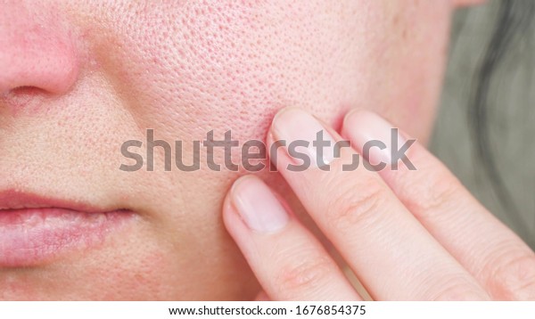 Macro skin with enlarged pores. The\
girl touches the irritated red skin with her\
fingers.