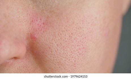 Macro Skin With Enlarged Pores. Skin With Sebum. Skin Contamination. Oily Skin.