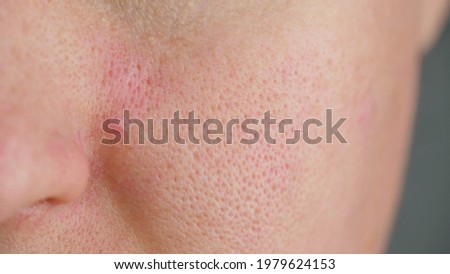 Macro skin with enlarged pores. Skin with sebum. Skin contamination. Oily skin.