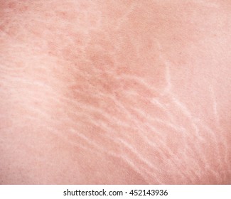 Macro Stretch Marks Of Skin On The Thigh