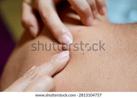 Macro View of Acne Pustule Extraction on Human Skin