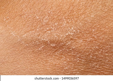 A macro view of human skin filling the frame, details of the lines and cracks and flaky shedding skin, skincare and dermatology concept with room for copy. - Shutterstock ID 1499036597