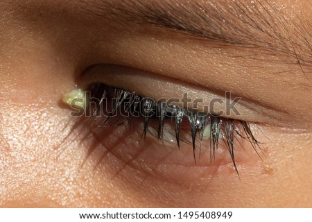 A macro view on the eye of a preschool boy, with red and puffy lower eyelid, yellow crusty discharge and watery lashes, symptomatic of viral conjunctivitis.