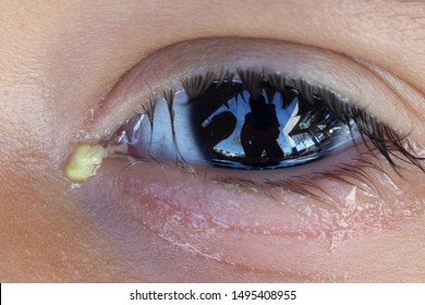 A macro view on the eye of a young boy suffering from childhood conjunctivitis. A contagious infection of the eyeball common in preschool toddlers. Teary eyes with yellow discharge.