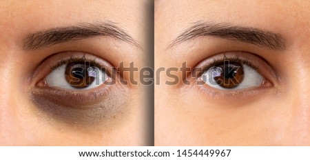 A macro view on the eye of a young lady. Showing before and after suffering from dark circles beneath the eye. Bruising is seen on the left and flawless complexion on the right.