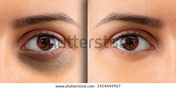A macro\
view on the eye of a young lady. Showing before and after suffering\
from dark circles beneath the eye. Bruising is seen on the left and\
flawless complexion on the\
right.