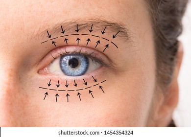 A macro view on the pretty blue eye of a Caucasian girl in her 30s. Arrows point in the direction of planned oculoplastic surgery to tighten and lift the skin around the eyes.