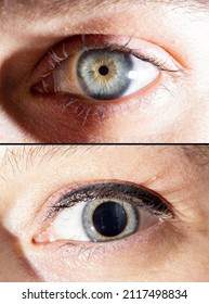 Macro View Side By Side Image Diluted Eye Pupils And Pupil Dilation Affected By Flash Light.