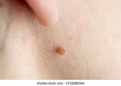 Macro View Of A Skin Tag On The Skin Of A Female Face