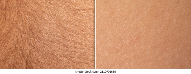 Macro of a woman's skin before and after an epilation treatment. Difference and comparison between skin with and without long hair. Permanent laser hair removal