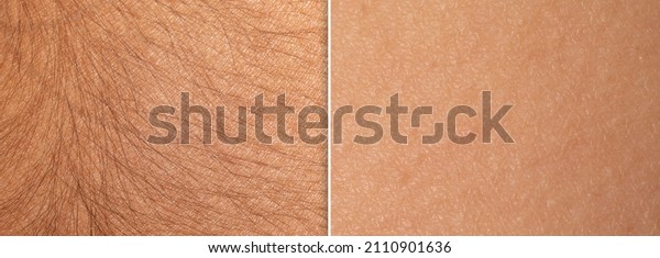 Macro of a woman's skin
before and after an epilation treatment. Difference and comparison
between skin with and without long hair. Permanent laser hair
removal