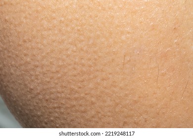 Macro Of Woman's Skin With Goosebumps, Close-up Of Spiky Hair, Concept Of Defense From Cold