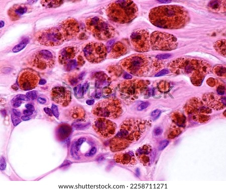 Macrophages heavily labelled with colloidal iron. Colloidal iron acts as a vital stain that can be introduced in the body being phagocyted by macrophages appearing as large brown cytoplasmic inclusion