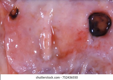 Macroscopic image of the surface of a gastric mucosa showing two ulcers with bloody contents. - Shutterstock ID 752436550