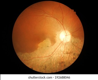 Macular Degeneration - Retina Isolated