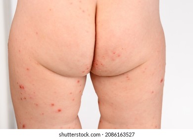 Maculopapular rash on skin of legs of a toddler infected with Hands, Foot and Mouth Disease caused by a strain of Cocksackie virus, an enterovirus from the Picoviridae family