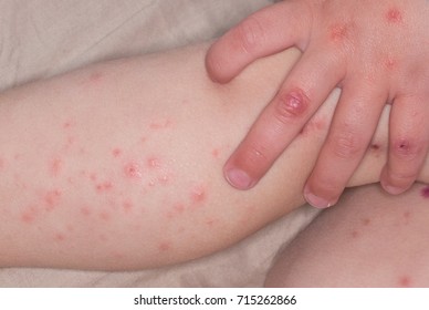 Maculopapular rash on skin of legs and hands of a toddler infected with Hands, Foot and Mouth Disease caused by a strain of Cocksackie virus, an enterovirus from the Picoviridae family
