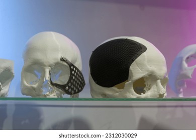 Madame of the human skull with implants made using 3D printing technology. Medicine