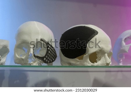 Madame of the human skull with implants made using 3D printing technology. Medicine