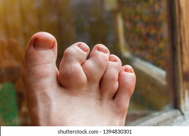 Maffucci syndrome of the toes with tumors of bone and soft tissue. The deformity cause foot pain and cosmetic concern. Painful gout inflammation on toe joints