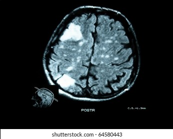 Magnetic Resonance Brain Lesions