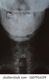 Magnetic Resonance Image Of Cervical Spine, Jaw And Of Neck,  Fixation With Pedicle Screw And Rod Of C6/7. X-ray Of Teeth. Dental X-ray Film Showing, Bone Loss, Patient With Removable Dentures