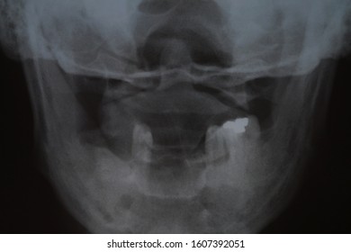 Magnetic Resonance Image Of Human Head And Jaw With Few Teeth. X-ray Of Teeth. Dental X-ray Film Showing, Bone Loss, Patient With Removable Dentures. 