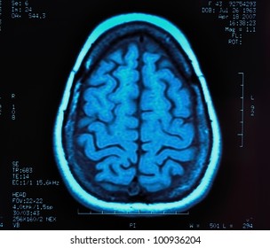 Magnetic Resonance Image (MRI) Of The Brain