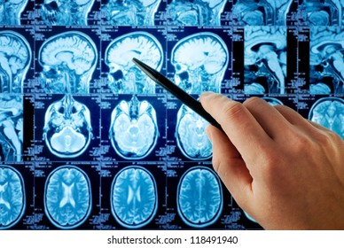 Magnetic Resonance Image (MRI) Of The Brain