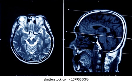 magnetic resonance image (MRI) of brain                                