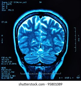 Magnetic Resonance Image (MRI) Of The Brain