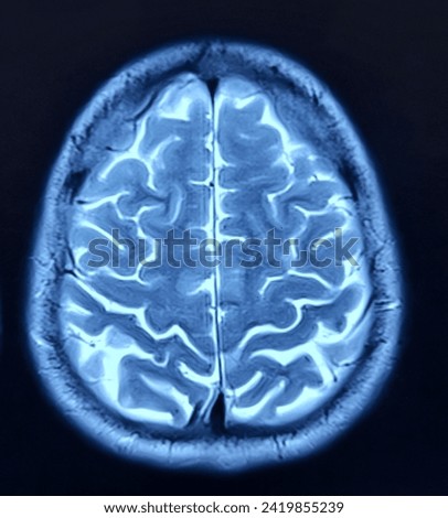 Magnetic resonance image (MRI) of the brain.