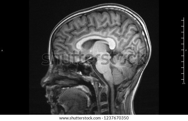 Magnetic Resonance Image Mri Brain Sagittal Stock Photo (Edit Now ...
