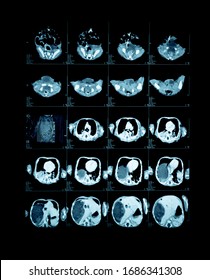 Magnetic Resonance Image (MRI) Of The Child Brain.