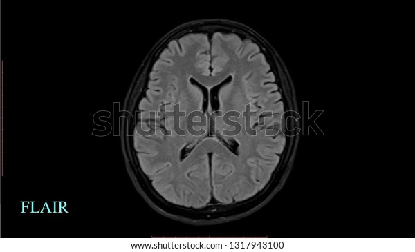 Magnetic Resonance Image Mri Normal Brain Stock Photo (Edit Now) 1317943100