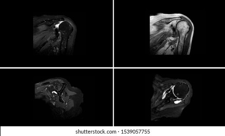 Magnetic Resonance Image Or MRI Of Shoulder Showing Rotator Cuff Tendon Tear. The Patient Has Chronic Shoulder Pain And Weakness. Medical Investigation Technology Concept