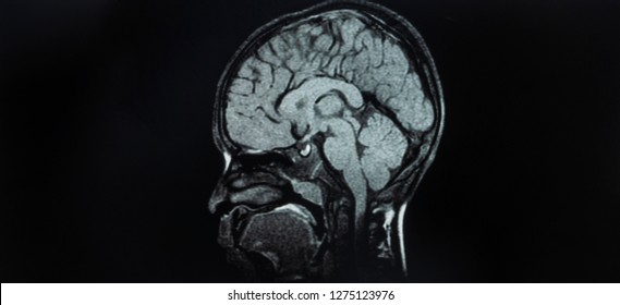 Magnetic resonance imaging of children brain in sagittal plain . MRI shown the cerebral cortex , Corpus callosum , brain stem and cerebellum on dark background with copy space. 