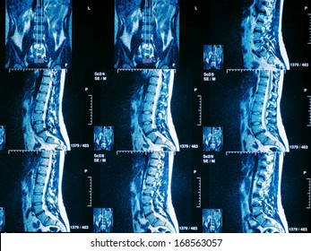 Magnetic resonance imaging of human spine (Discus Hernia) - Powered by Shutterstock