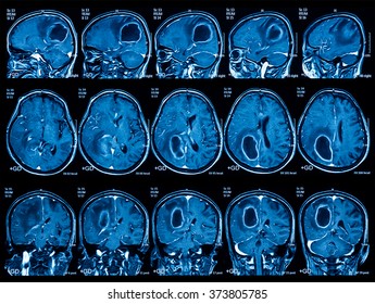 Magnetic resonance imaging (MRI) of the brain, brain tumor, three views (sagittal, coronal and transverse)