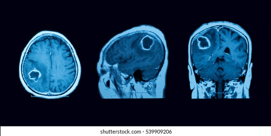 Magnetic resonance imaging (MRI) of the brain, case of intracerebral hemorrhage (ICH), three views (sagittal, coronal and transverse)