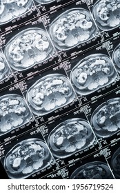 
Magnetic Resonance Imaging, MRI, Computed Tomography, X-ray Image.
Abdominal Area In Cross Section
Area Of ​​the Pelvis With Kidneys Infected With Tumors