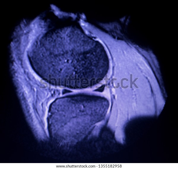 Magnetic Resonance Imaging Mri Knee Posterior Stock Photo 1355182958 ...