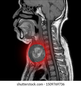 Magnetic Resonance Imaging (MRI) Of Neck, Sagittal View, A Case Of Neck IMPRESSION:-Deep Neck Infection In Retropharyngeal Space Cyst At Lower Pole Of Lt Lobe Of Thyroid.